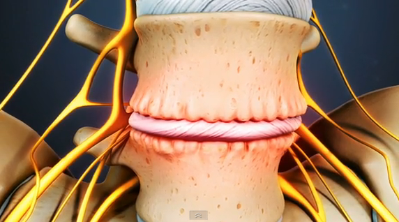 Anterior Lumbar Interbody Fusion (ALIF) – Jeffrey R McConnell, M.D.