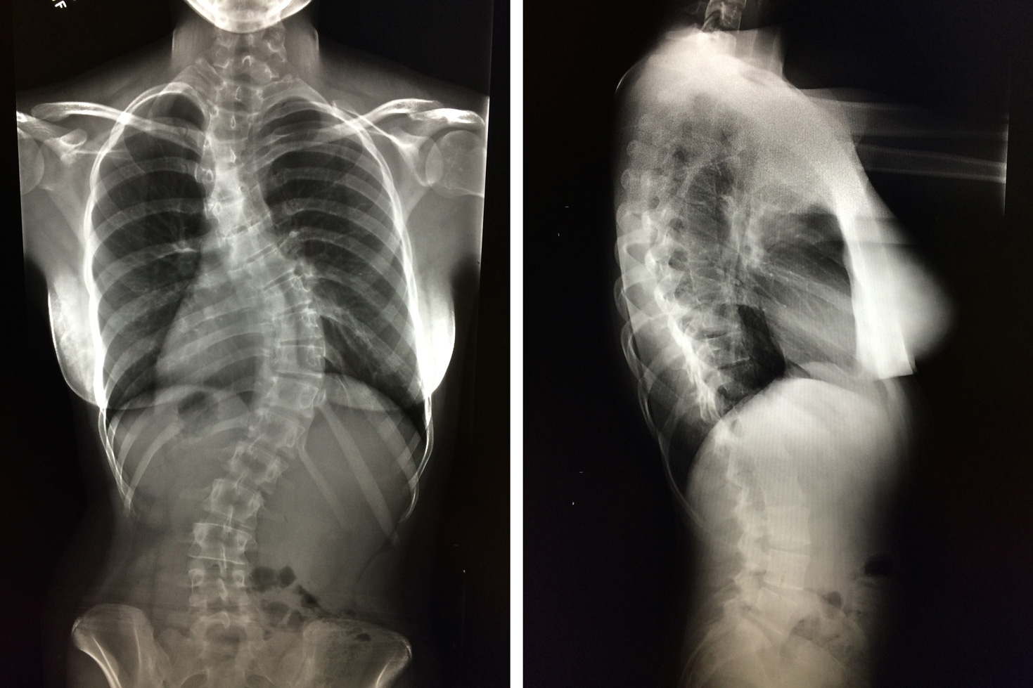 Scoliosis Side View